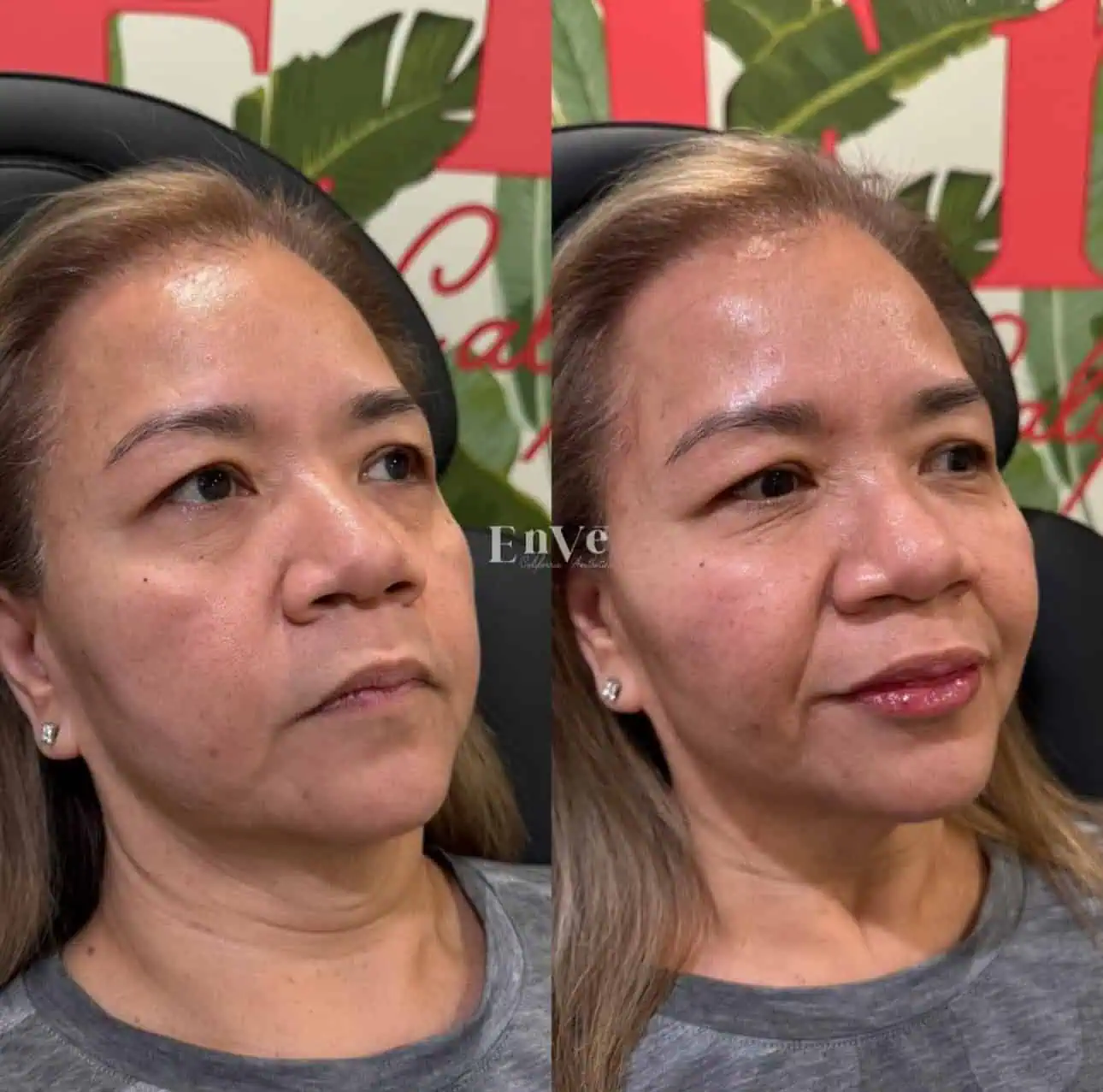 Lip Filler Before and After 5 At Enve California Aesthetics
