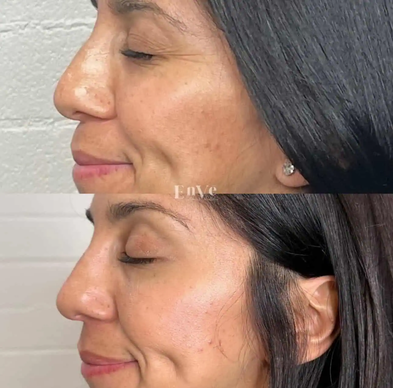 woman's face before after Botox treatment, showing visible forehead lines and frown wrinkles.