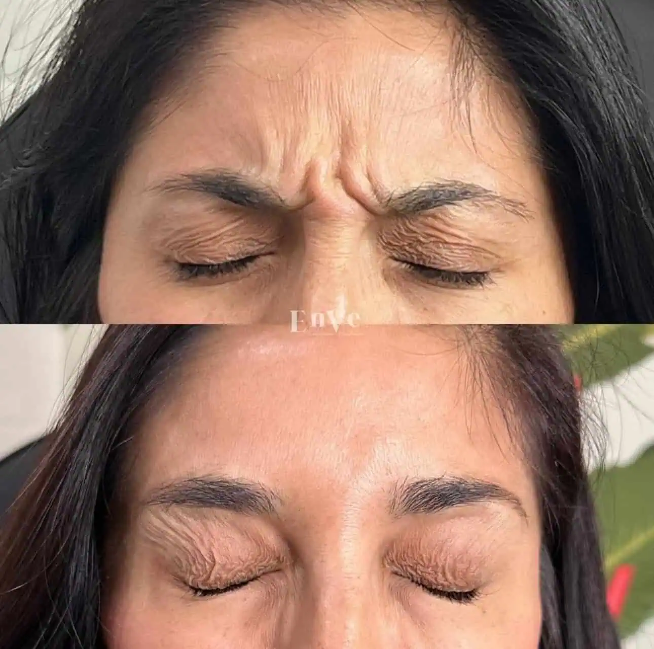 Close-up of a woman receiving a Botox injection in the forehead.