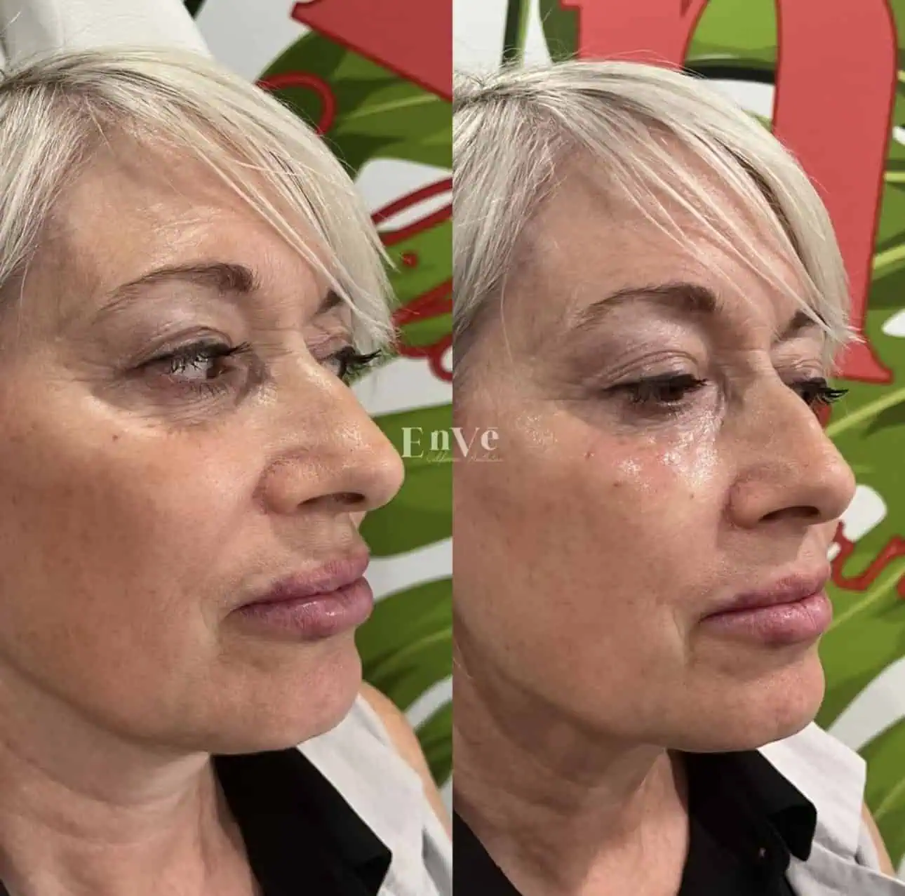 Full Face Filler Before and After12 in Palm Springs & Orange County CA