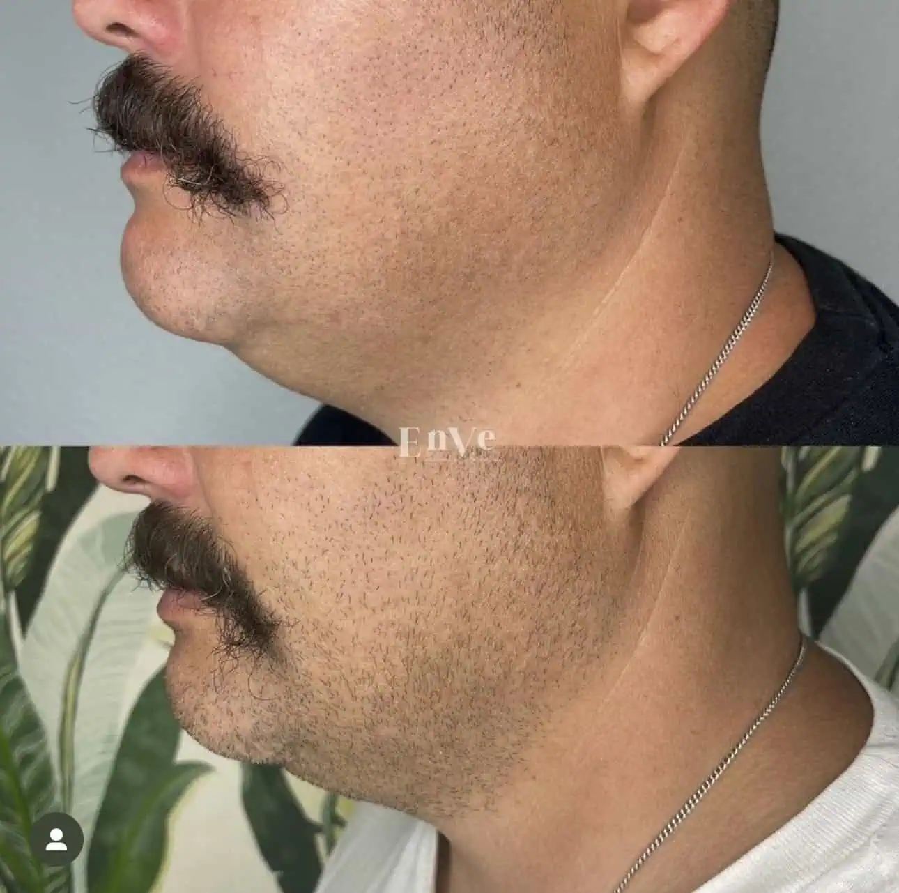 woman’s face post-aesthetic procedure at Enve California Aesthetics in Palm Springs, CA – showing lifted features and smoother skin