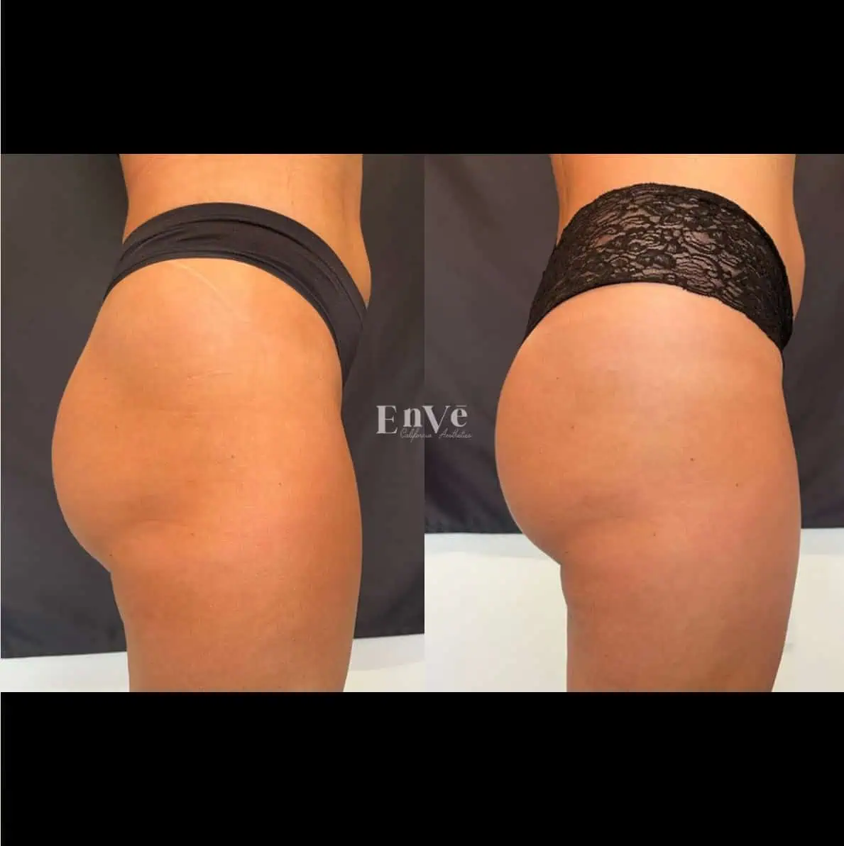 Radiesse Booty treatment results at Enve California Aesthetics in Palm Springs, CA enhanced volume and contour in the buttocks area.