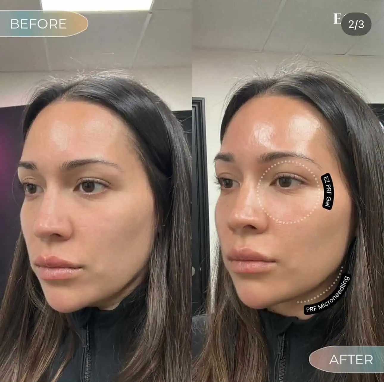 Female patient after aesthetic treatment at Enve California Aesthetics in Palm Springs, CA – showing natural, rejuvenated skin results.