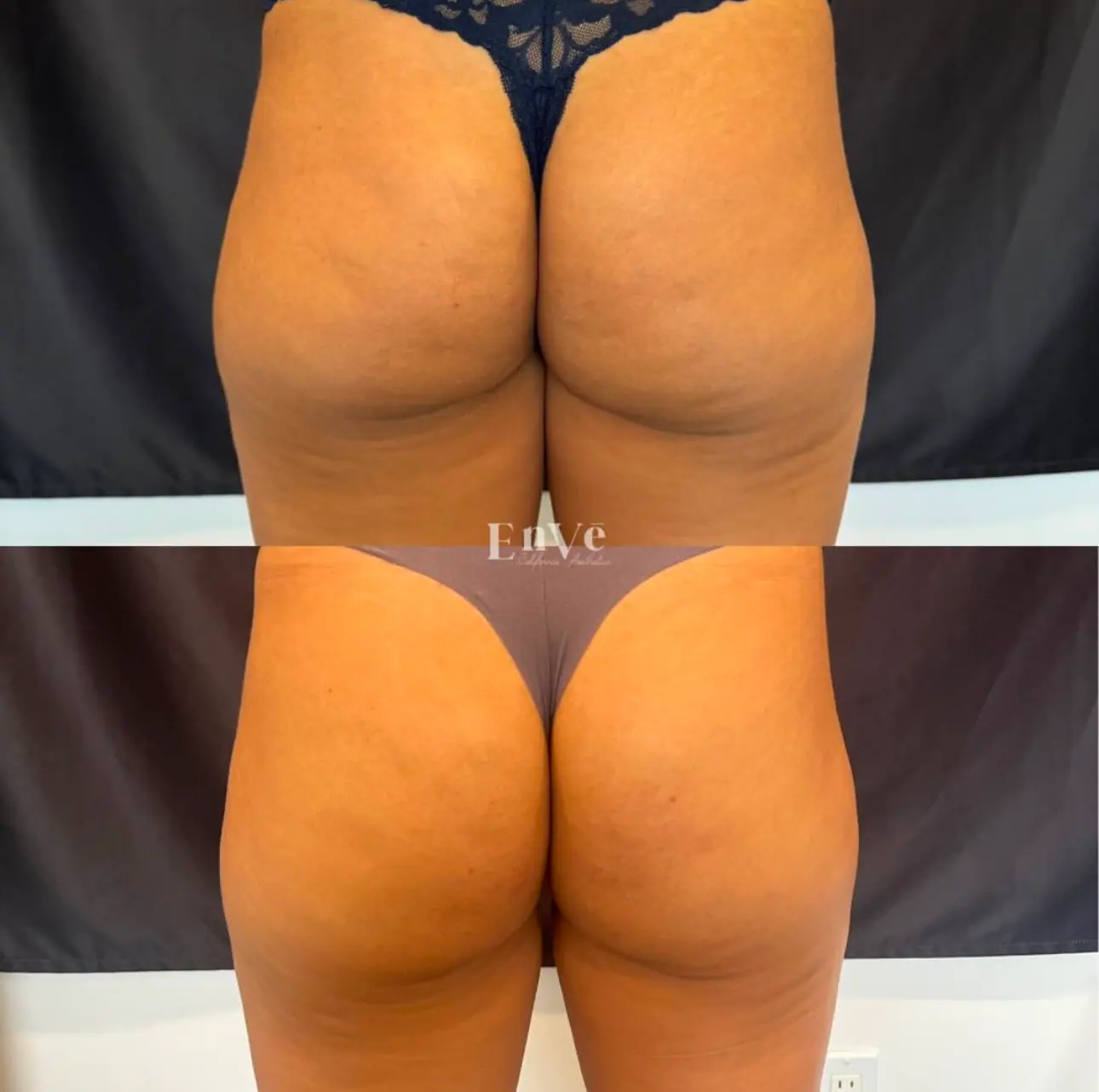 Radiesse Booty treatment at Enve California Aesthetics in Palm Springs, CA highlighting lifted and fuller buttocks with improved skin texture.