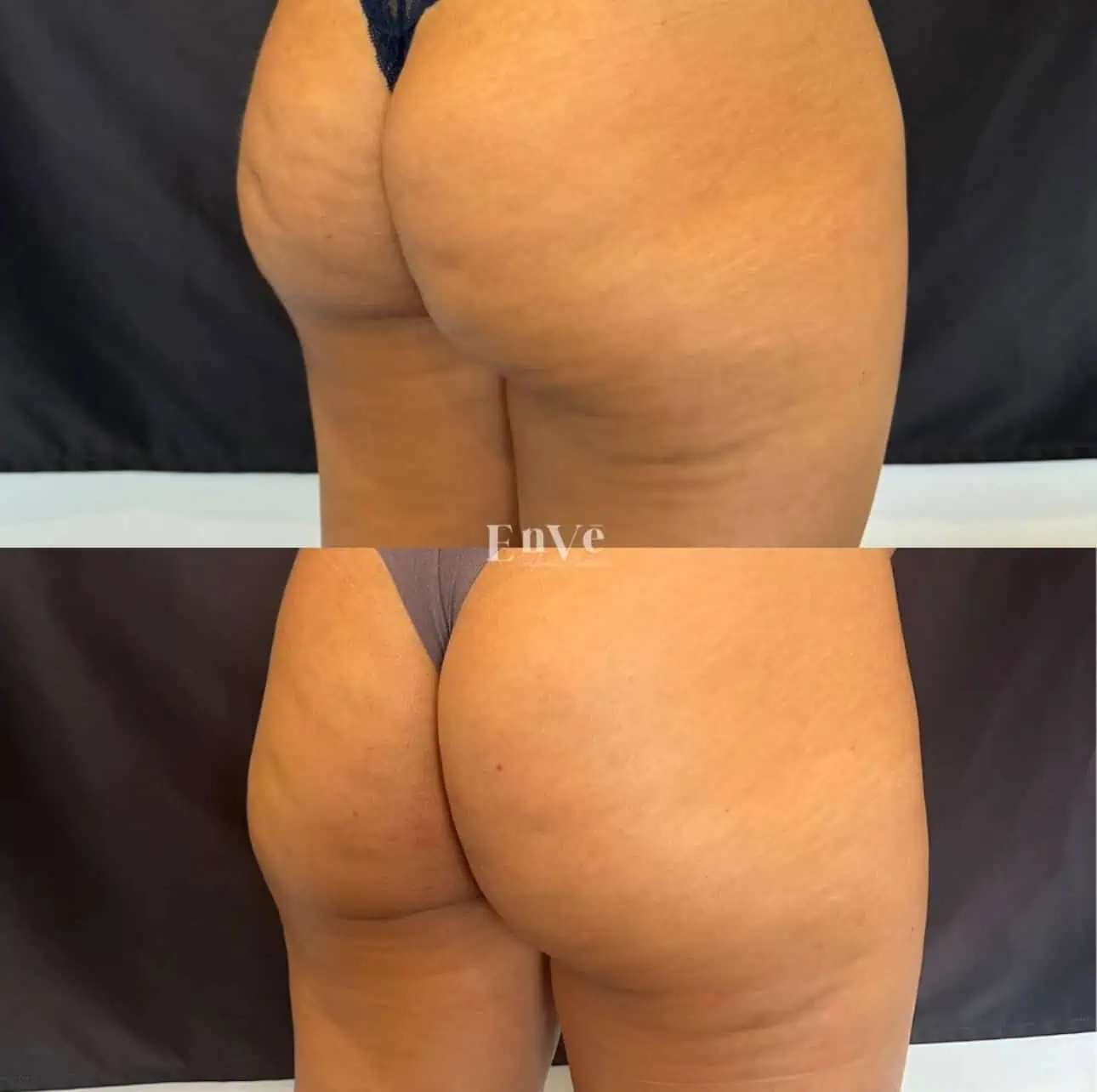 After Radiesse Booty enhancement at Enve California Aesthetics in Palm Springs, CA