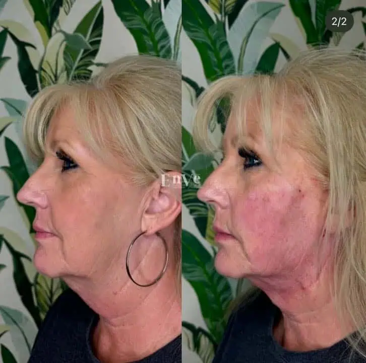Female patient Chin Filler treatment result before after at Enve California Aesthetics in Palm Springs, CA – highlighting smooth skin and defined facial features.