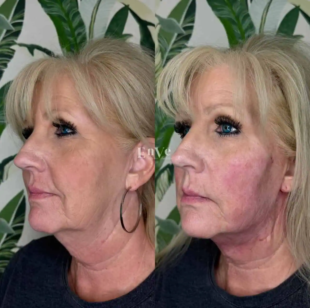 Woman after cosmetic treatment at Enve California Aesthetics in Palm Springs, CA – showcasing rejuvenated skin and enhanced facial contours.