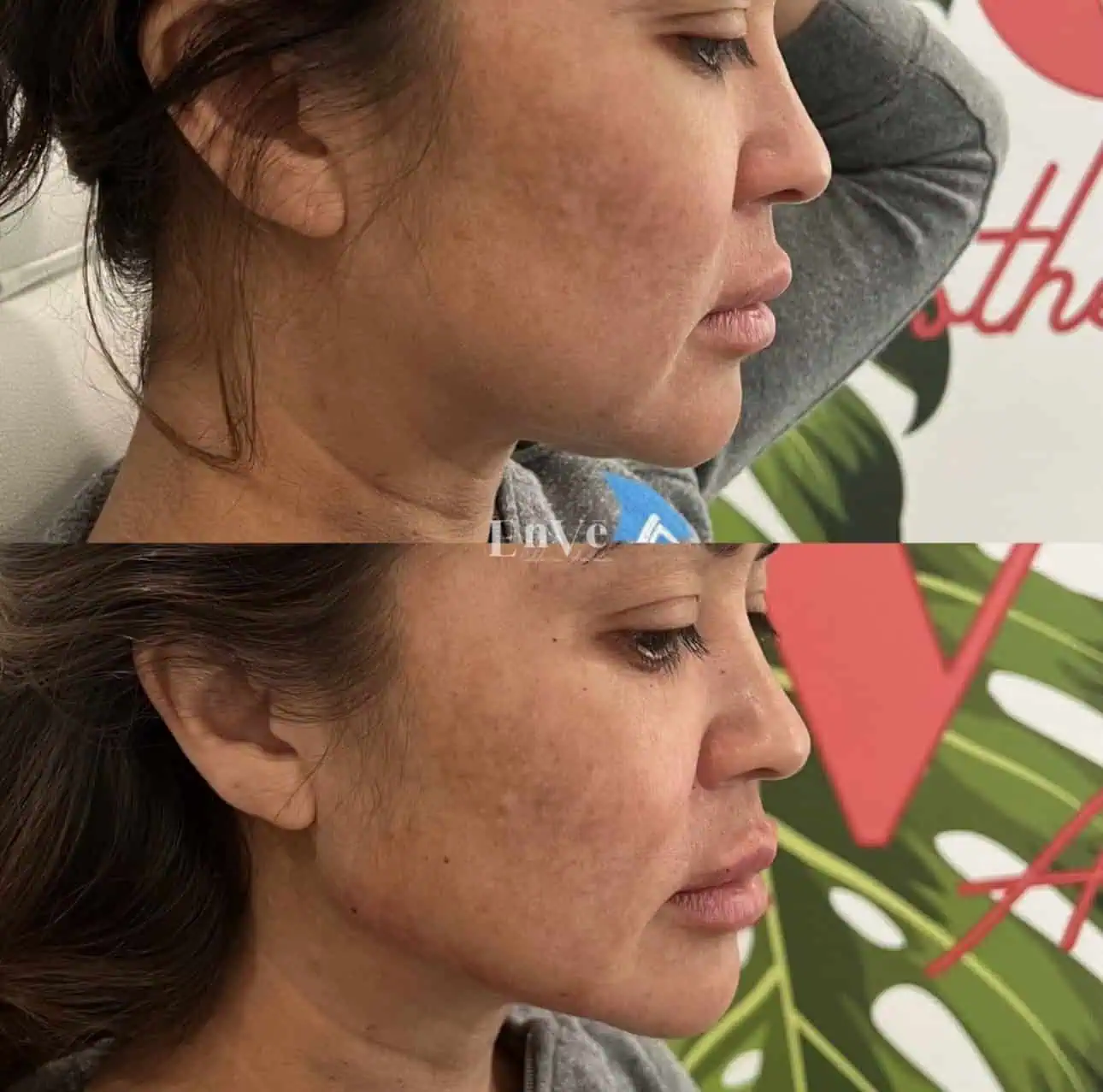 Chin Filler Before and After4 in Palm Springs & Orange County CA