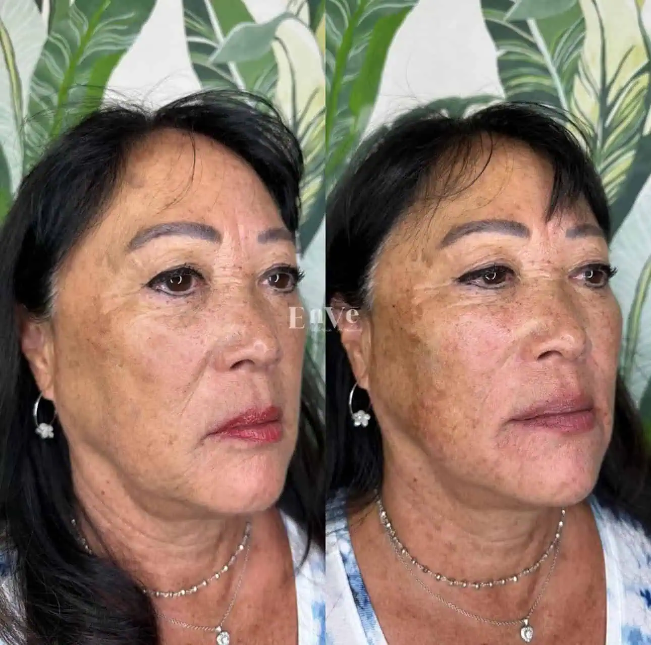 PDO Threads Before and After5 in Palm Springs & Orange County CA