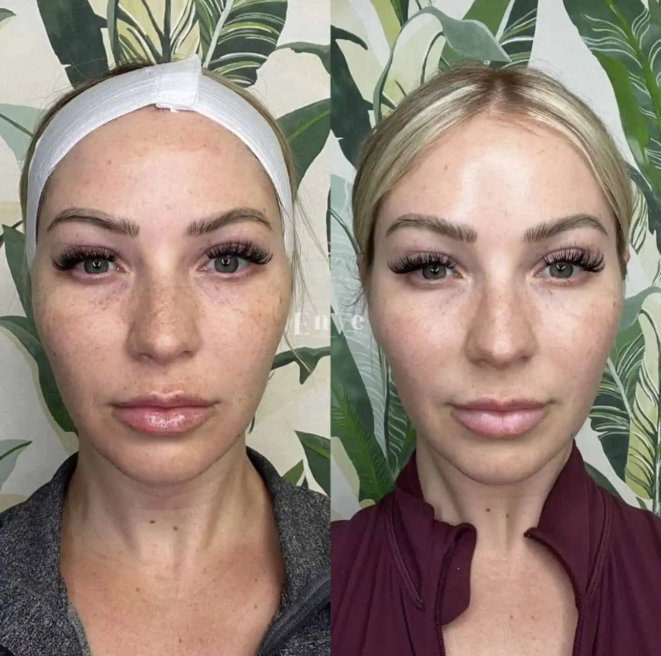 EZ PRF + Gel in Palm Springs & Orange County CA