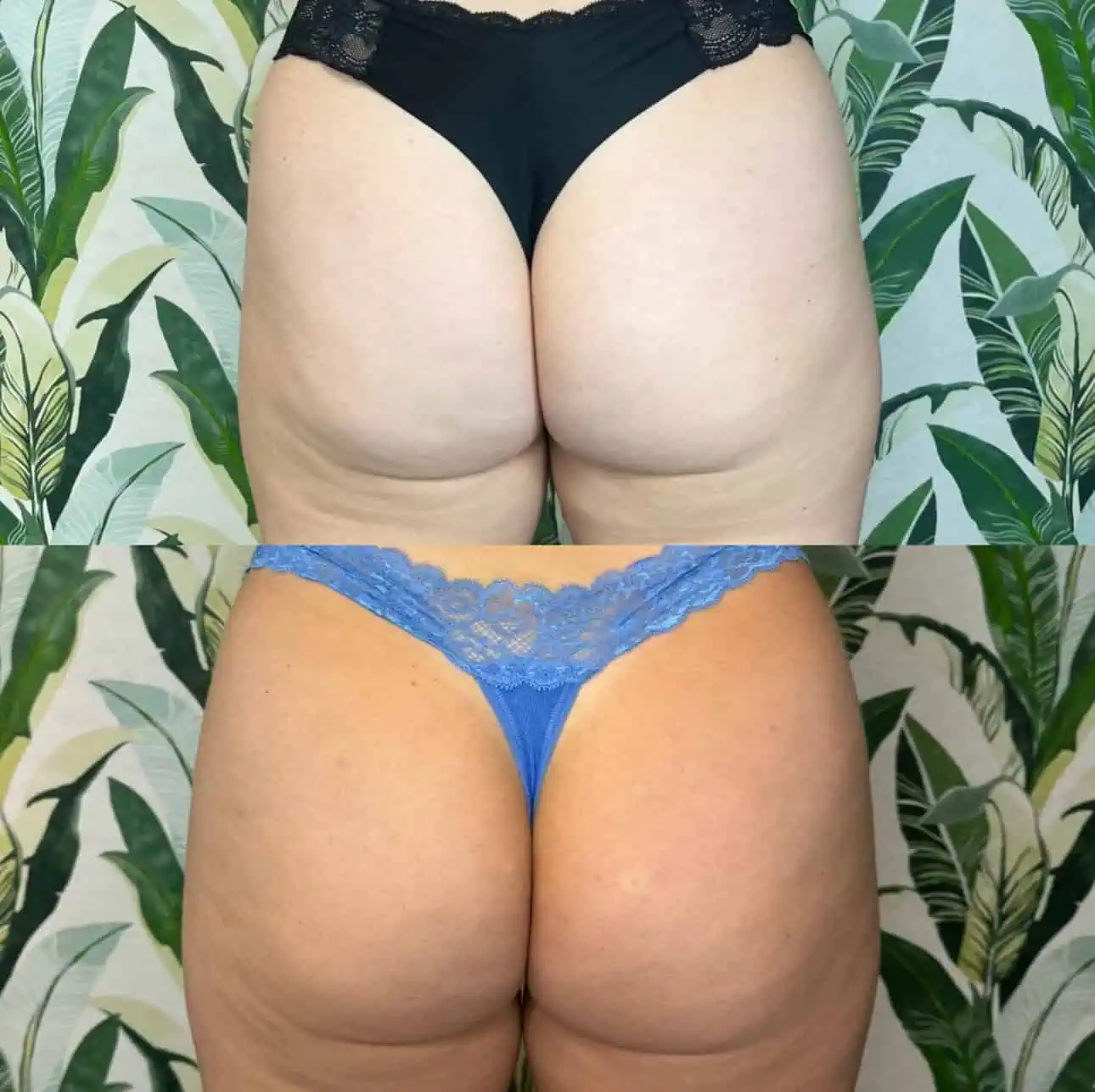 Radiesse Booty treatment results at Enve California Aesthetics in Palm Springs, CA – demonstrating enhanced curves and improved buttock symmetry.