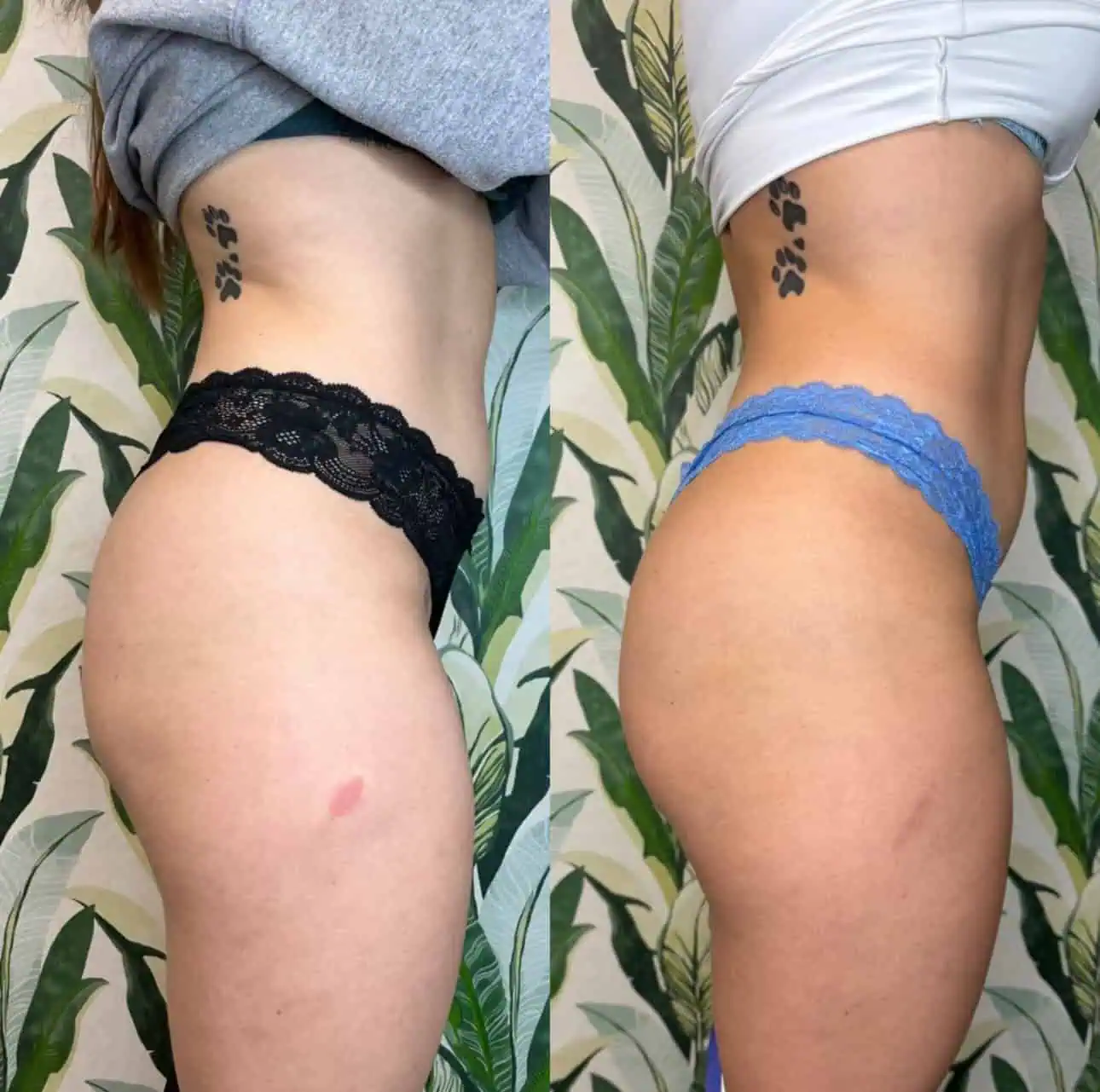 Radiesse Booty enhancement at Enve California Aesthetics in Palm Springs, CA – highlighting improved volume, lift, and natural contour.