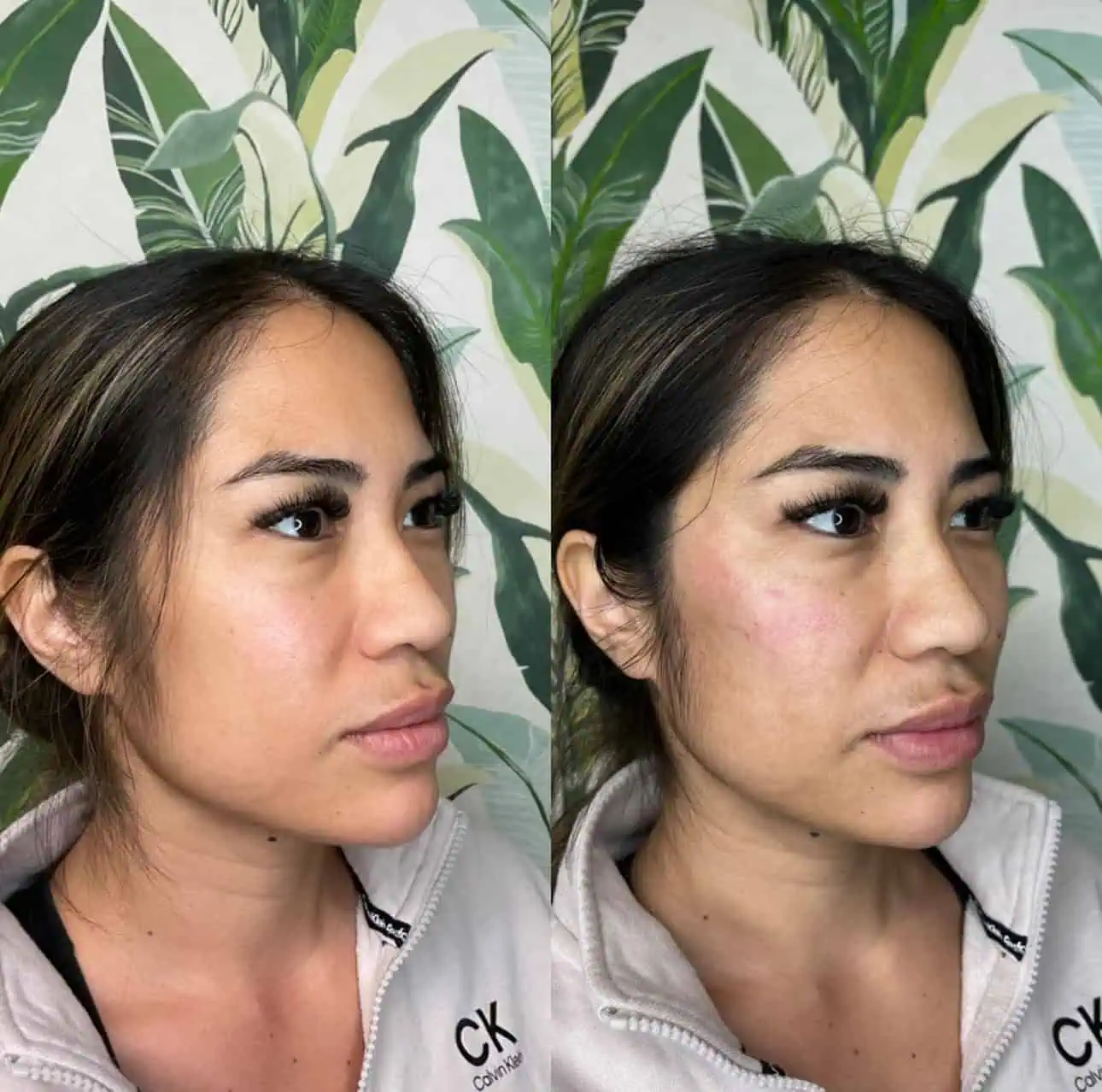 Check Filler Before and After 6 At Enve California Aesthetics