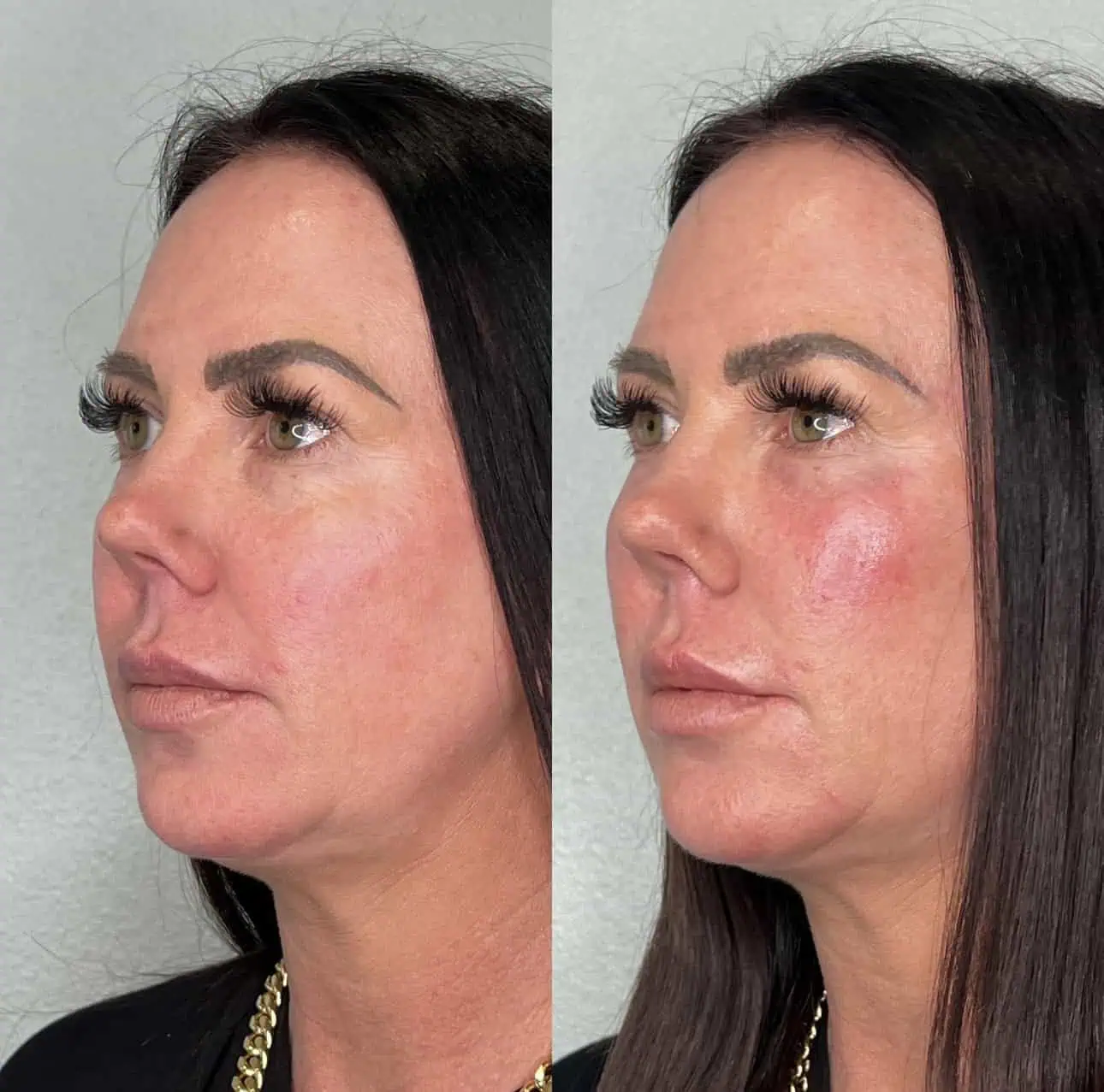 Woman after cosmetic procedure at Enve California Aesthetics in Palm Springs, CA – showcasing refreshed and glowing complexion.