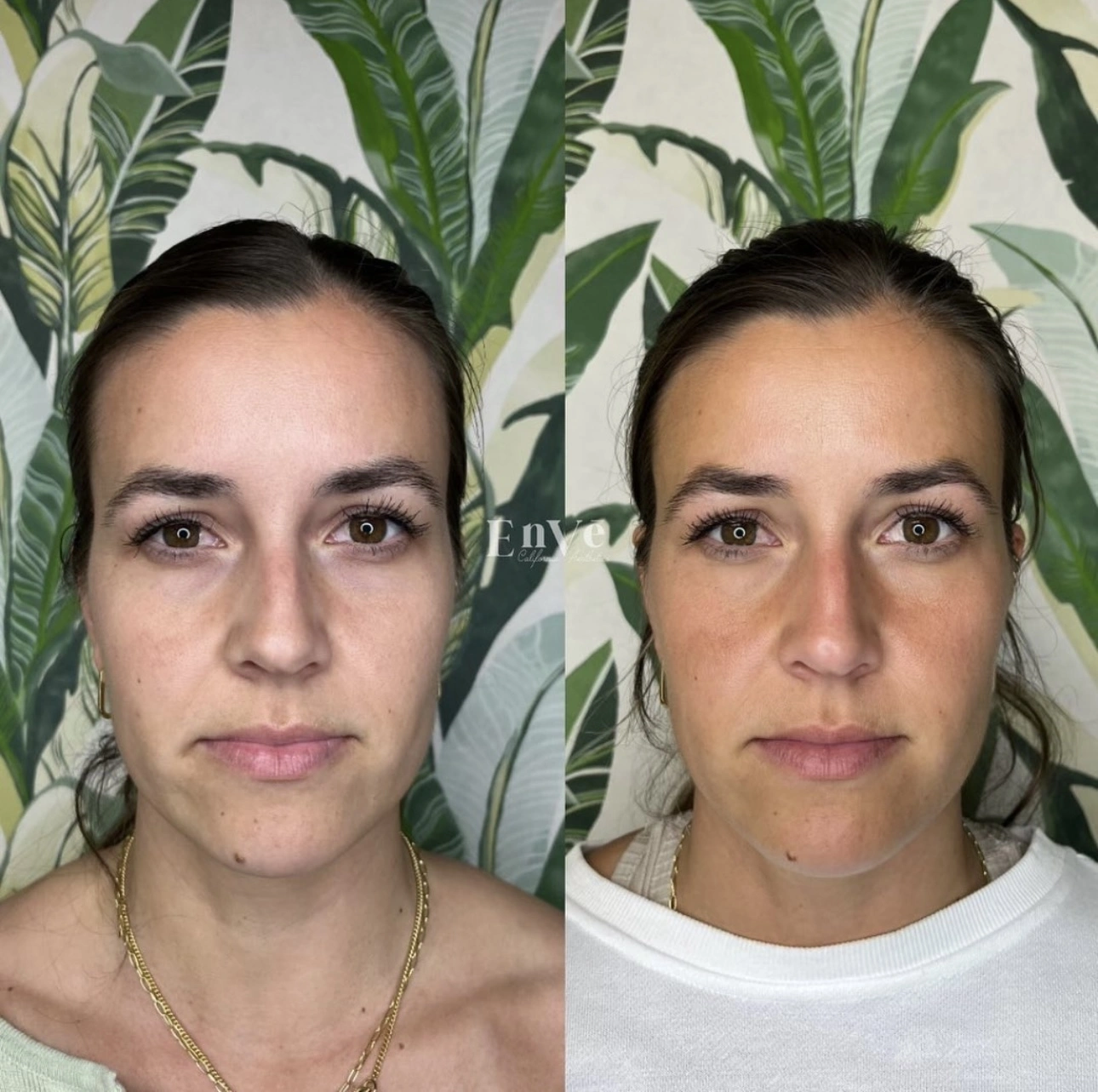 Sculptra Before and After4 at Enve California Aesthetics