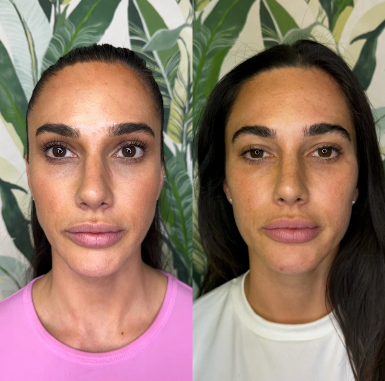 Sculptra Before and After3 at Enve California Aesthetics