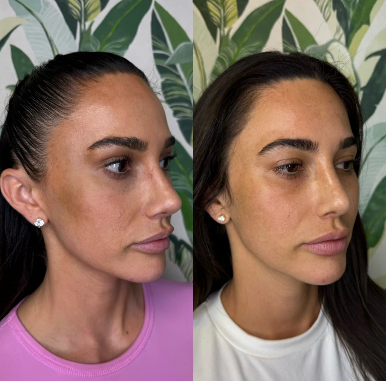 Sculptra Before and After1 at Enve California Aesthetics