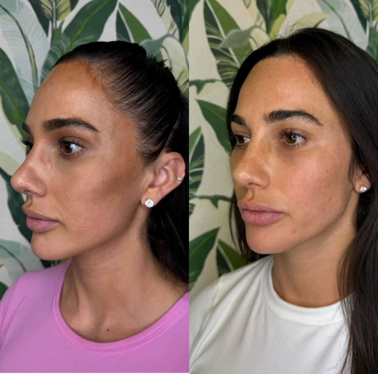 Sculptra Before and After at Enve California Aesthetics