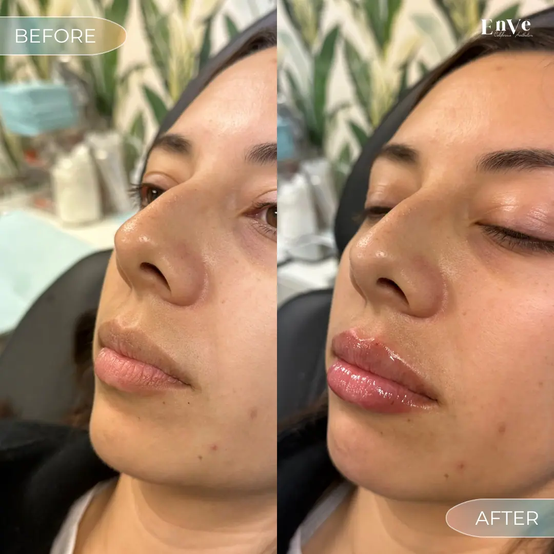 Lip Filler Before and After 20 At Enve California Aesthetics