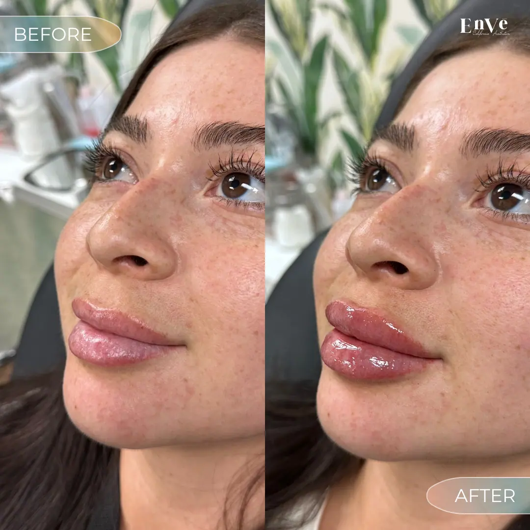 Lip Filler Before and After 21 At Enve California Aesthetics