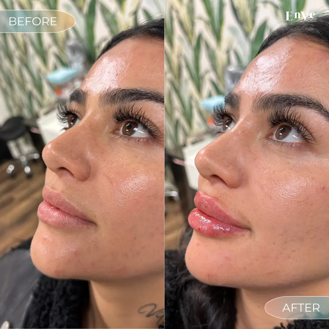 Lip Filler Before and After 22 At Enve California Aesthetics