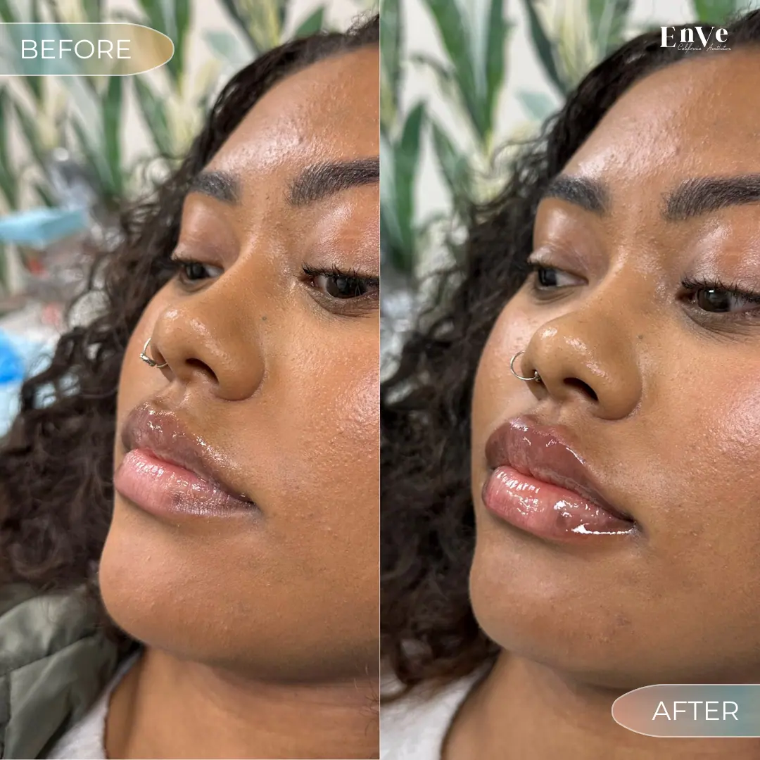Lip Filler Before and After 23 At Enve California Aesthetics