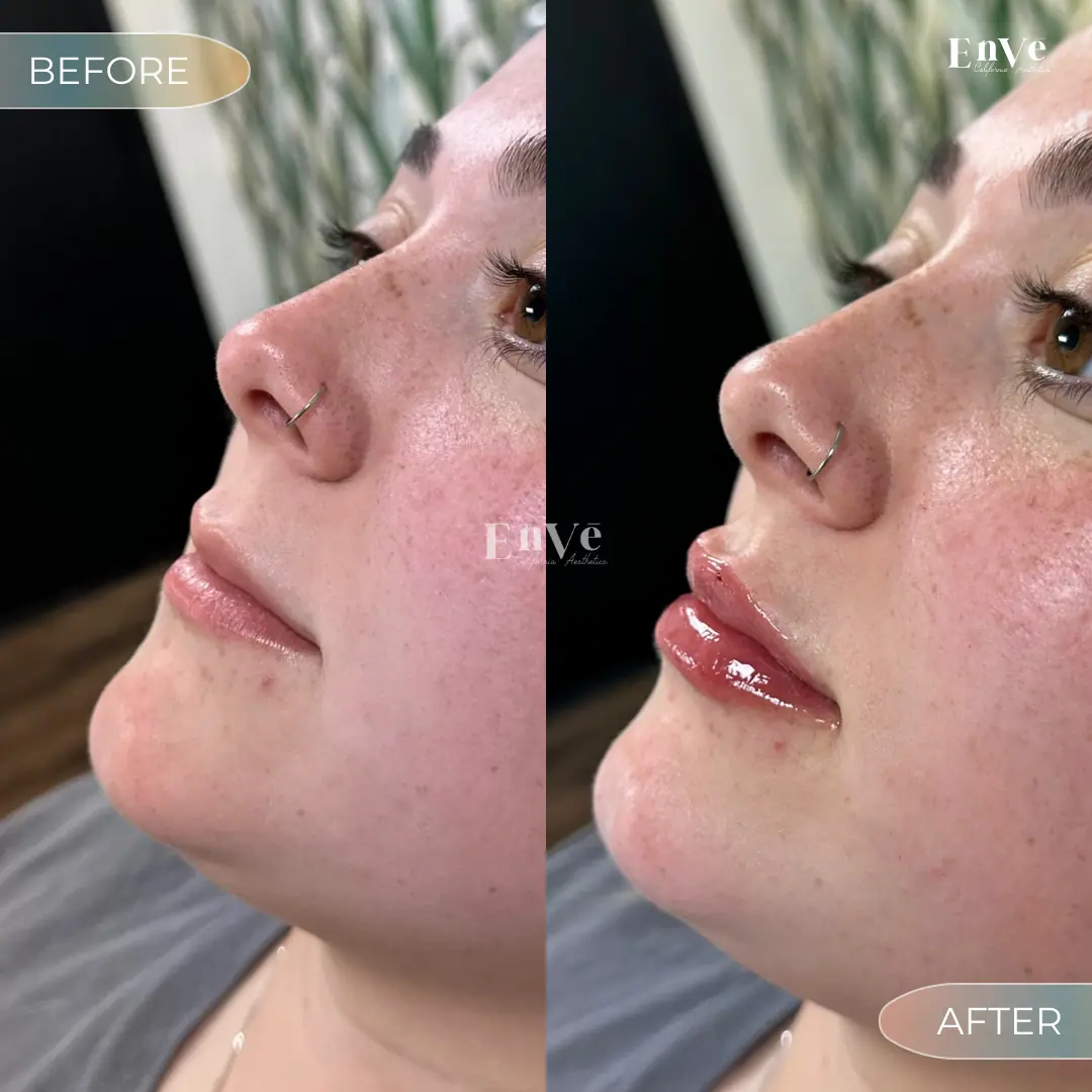 Lip Filler Before and After 24 At Enve California Aesthetics