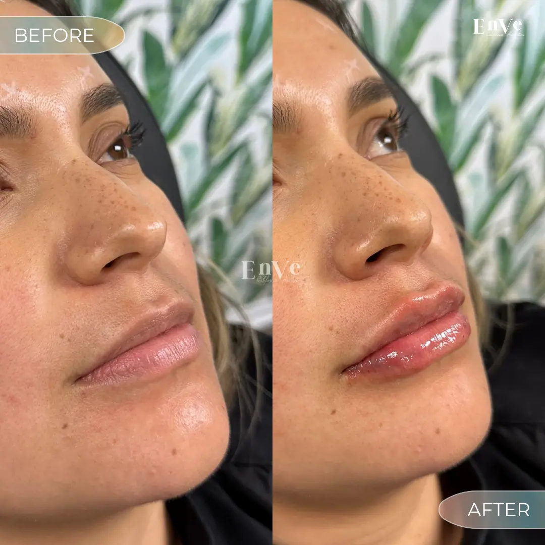 Lip Filler Before and After 25 At Enve California Aesthetics
