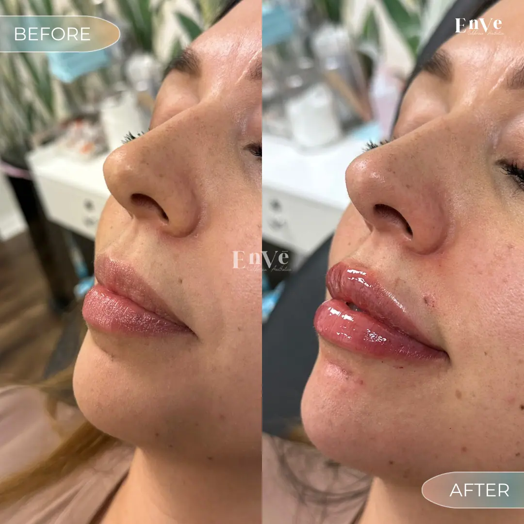 Lip Filler Before and After 27 At Enve California Aesthetics