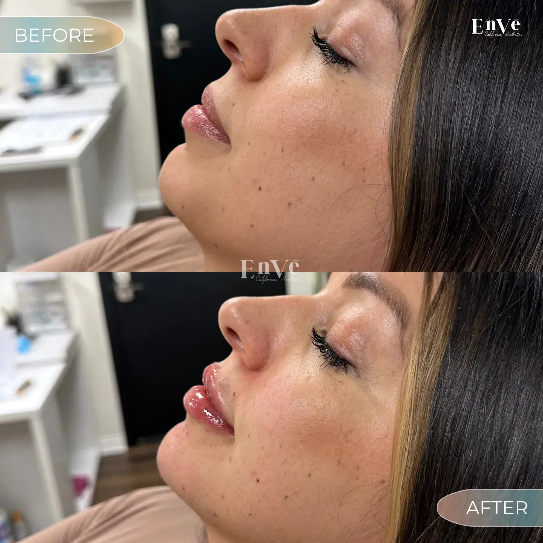Check Filler Before and After 12 At Enve California Aesthetics
