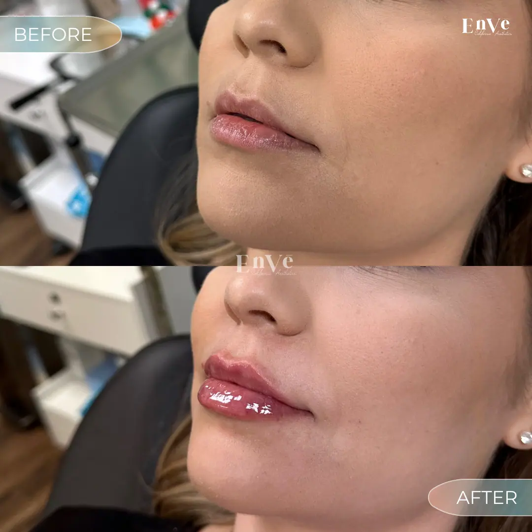 Lip Filler Before and After 27 At Enve California Aesthetics