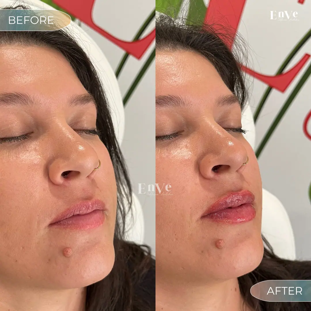 Lip Filler Before and After 28 At Enve California Aesthetics