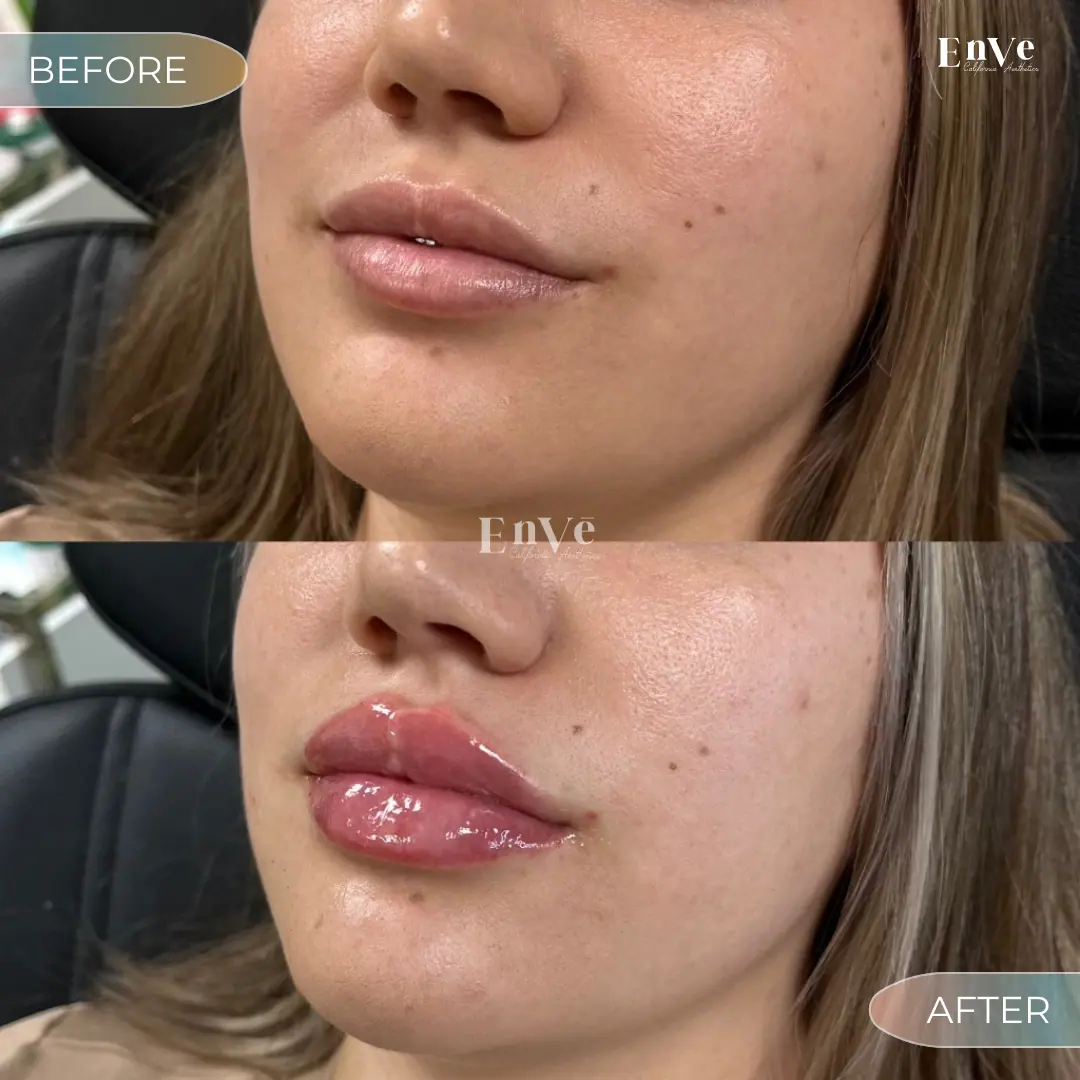 Lip Filler Before and After 29 At Enve California Aesthetics