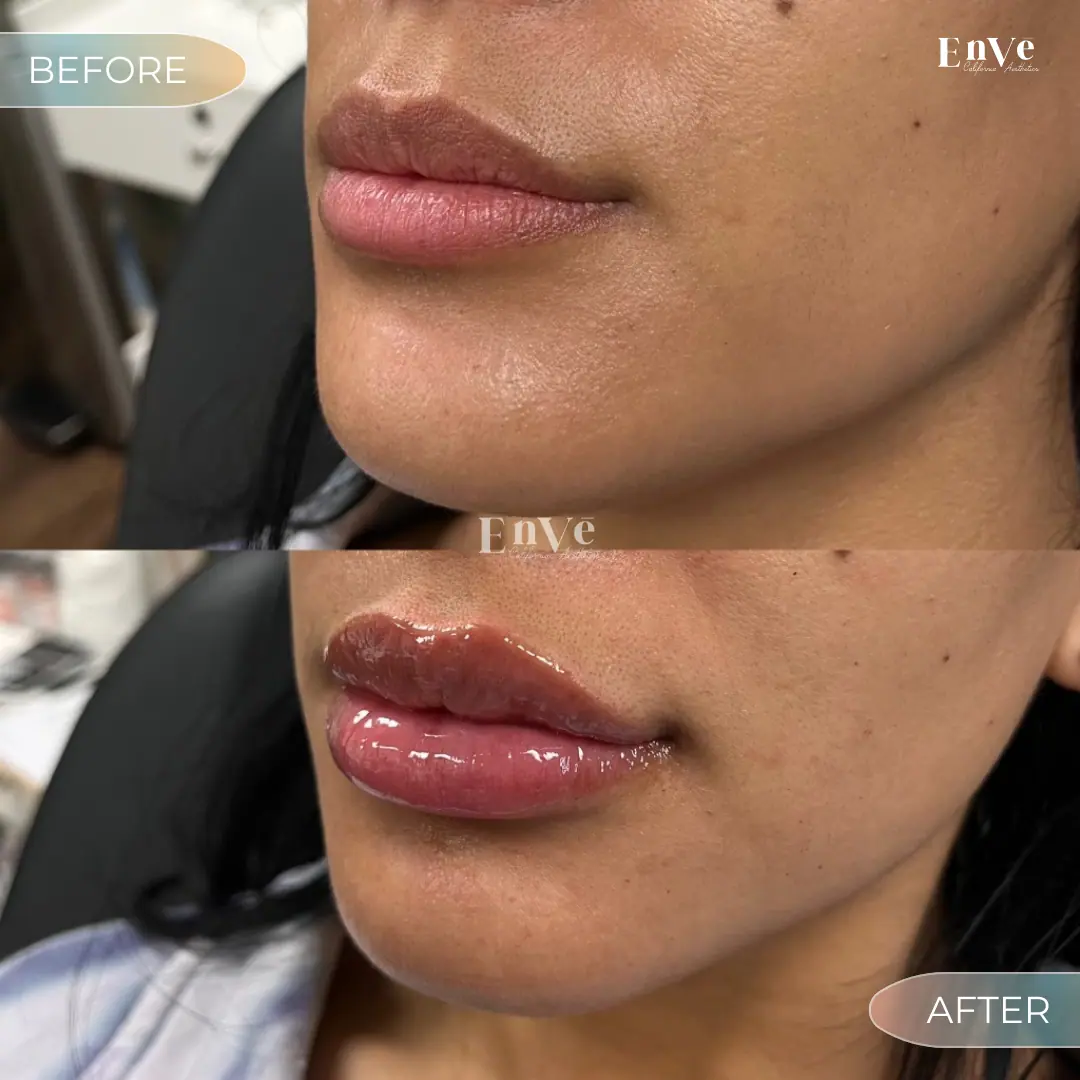 Lip Filler Before and After 30 At Enve California Aesthetics