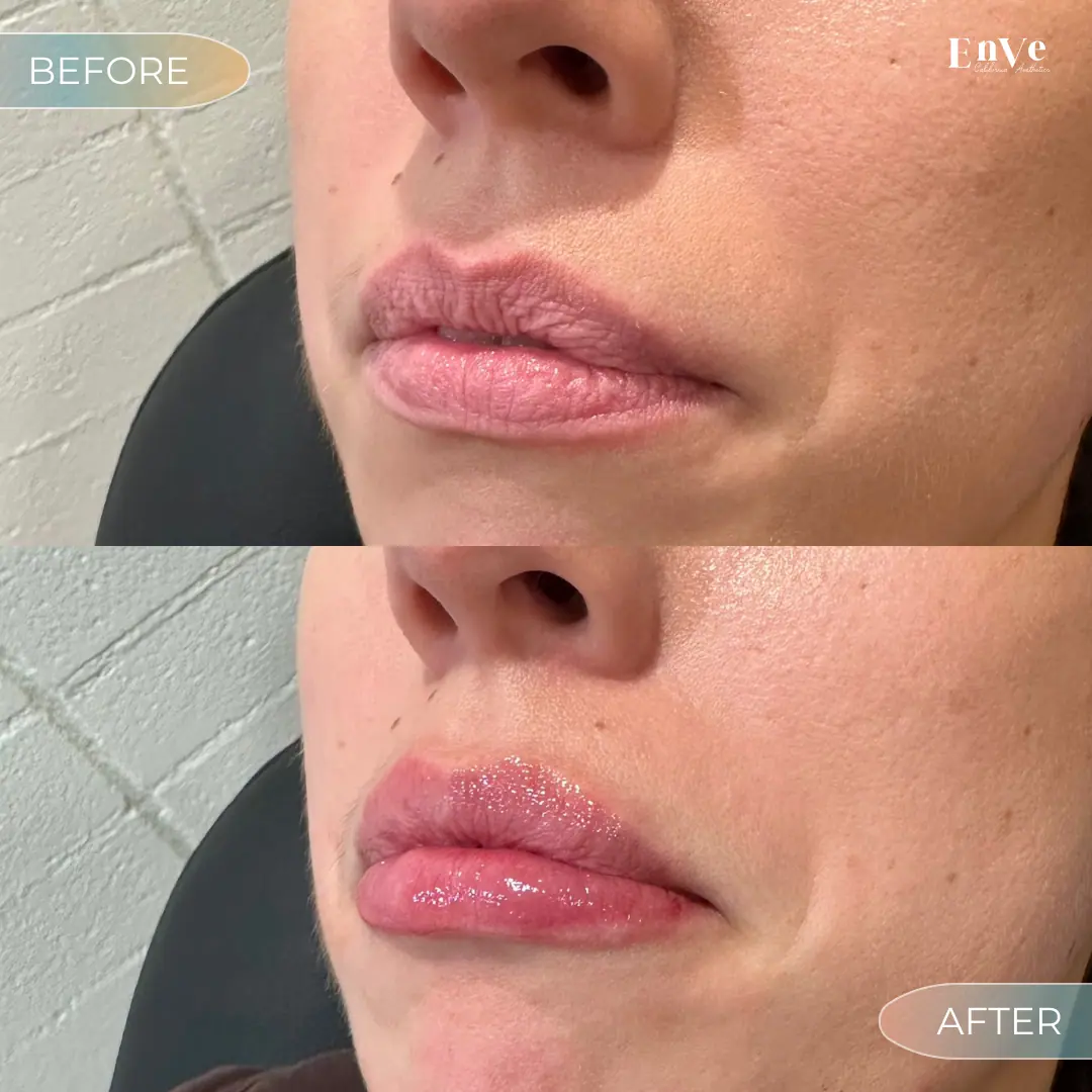 Lip Filler Before and After 31 At Enve California Aesthetics