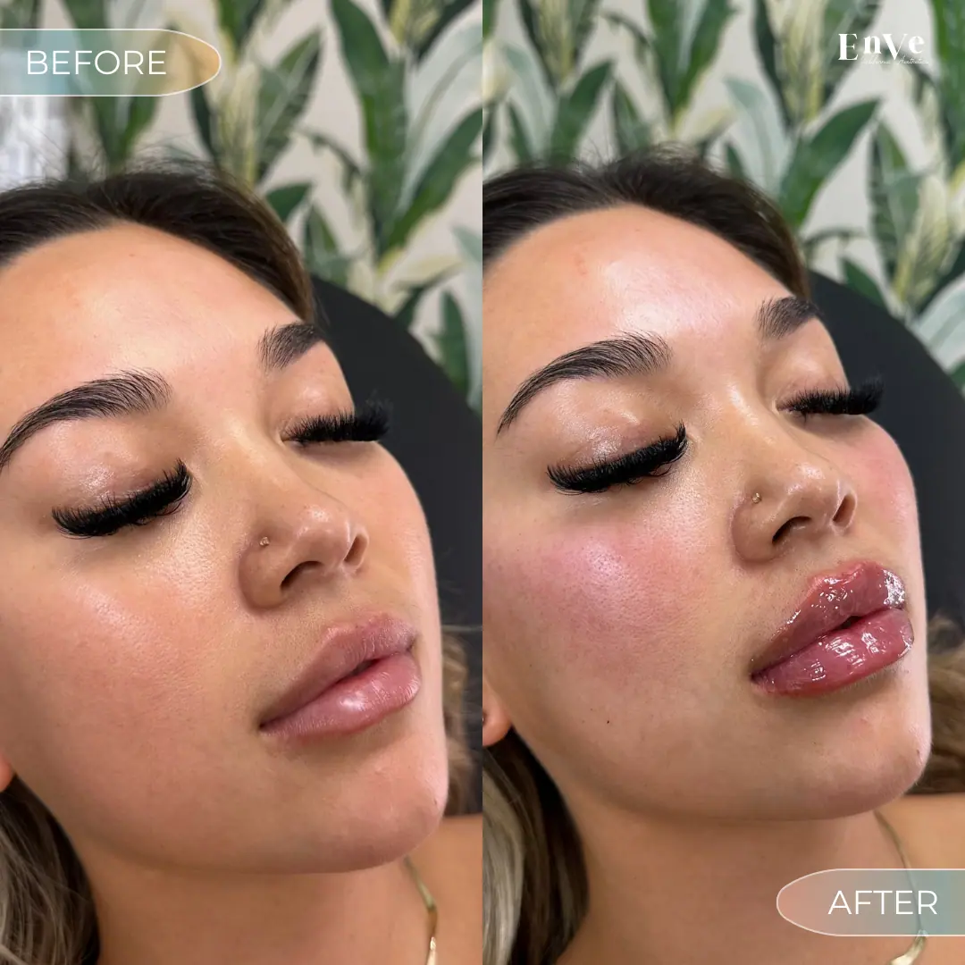 Lip Filler Before and After 18 At Enve California Aesthetics