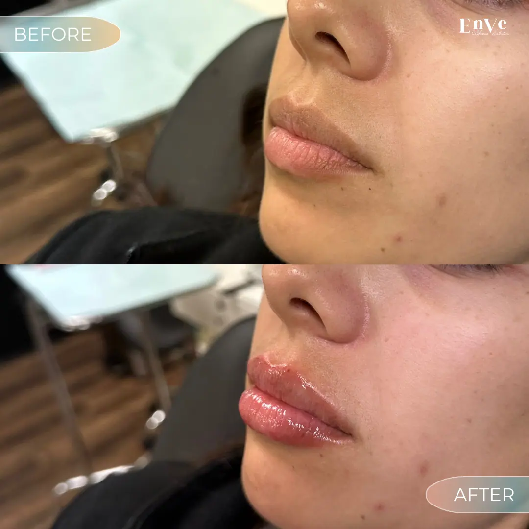 Lip Filler Before and After 19 At Enve California Aesthetics