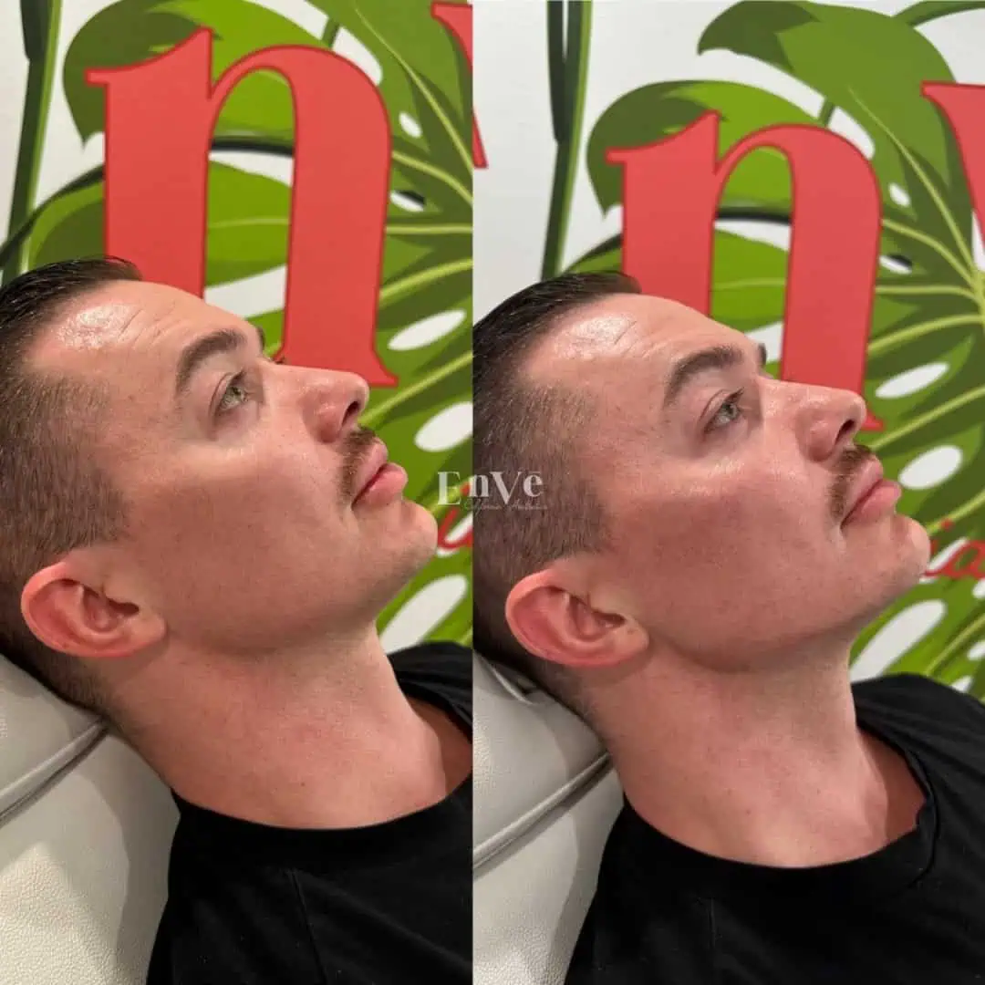 Under Eye Filler Before and After8 in Palm Springs & Orange County CA