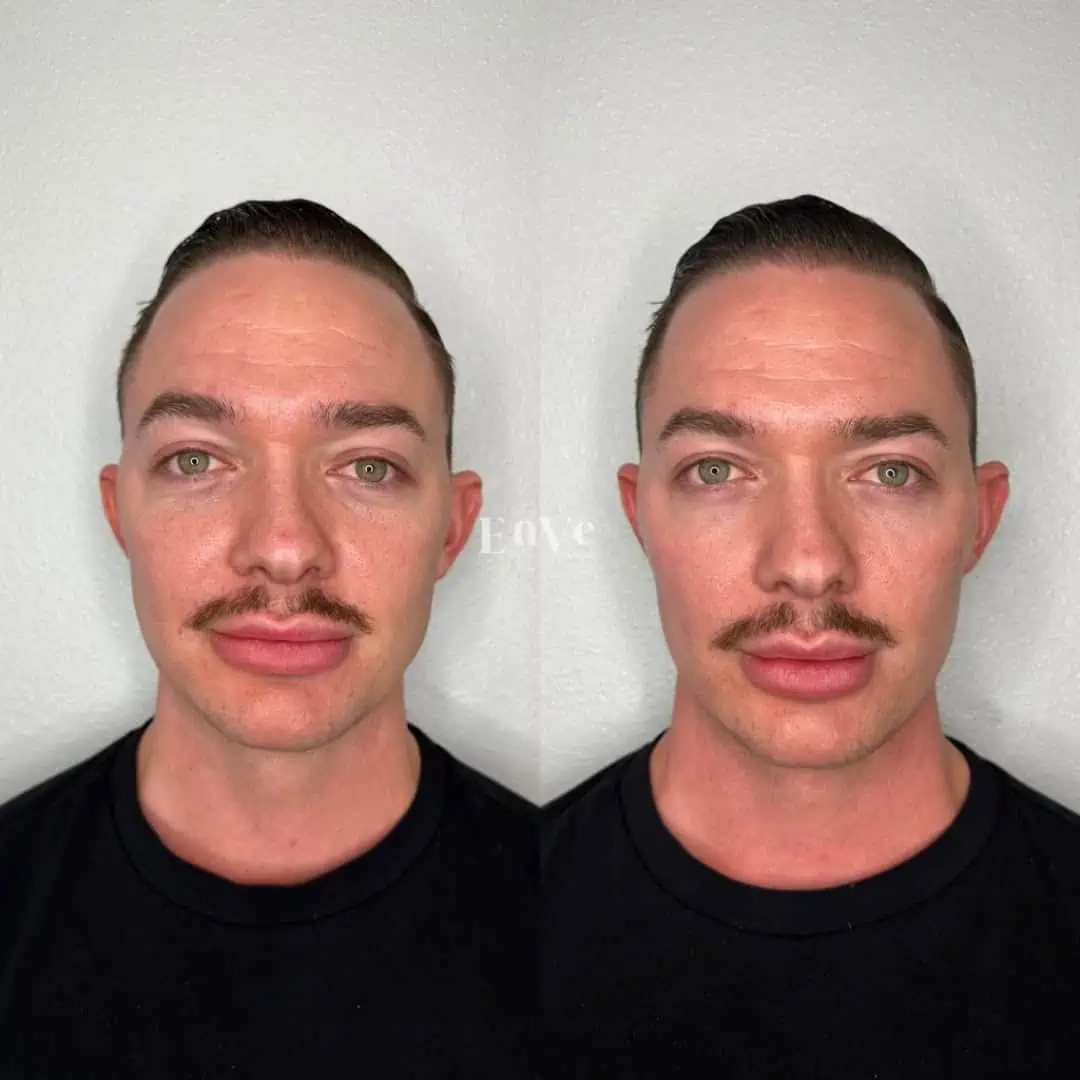 Full Face Filler Before and After6 in Palm Springs & Orange County CA