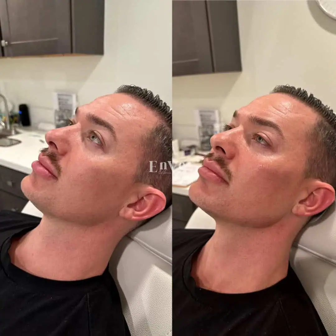 Chin Filler Before and After9 in Palm Springs & Orange County CA