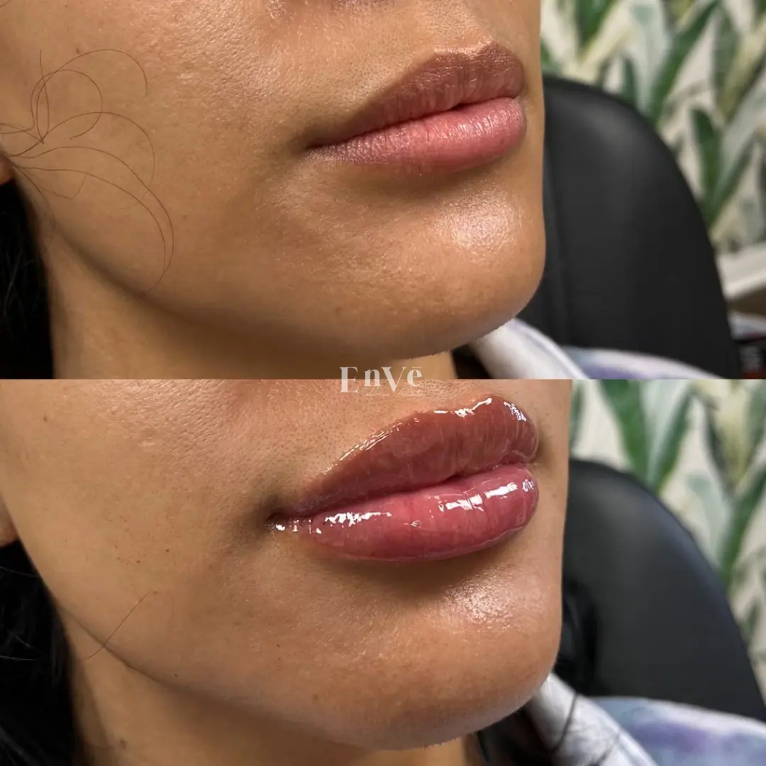 Visible skin transformation after treatment, showing reduced pigmentation and improved clarity from facial procedures at Enve California Aesthetics.