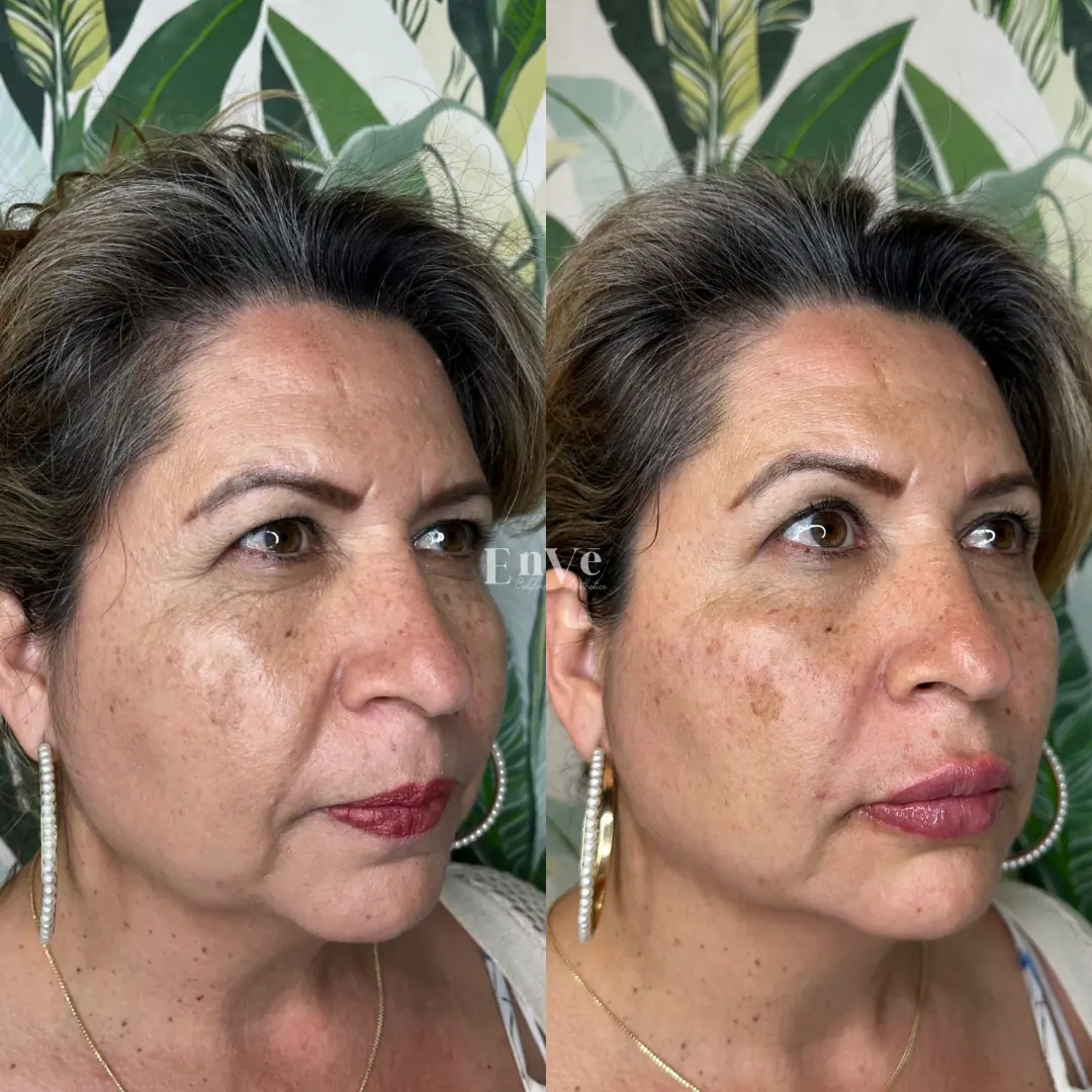 Check Filler Before and After 8 At Enve California Aesthetics