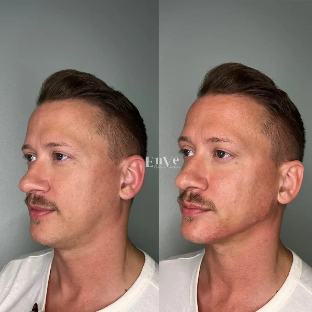 Scupsure Before and After8 in Palm Springs & Orange County CA