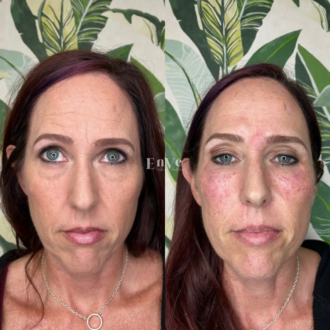 Under Eye Filler Before and After in Palm Springs & Orange County CA