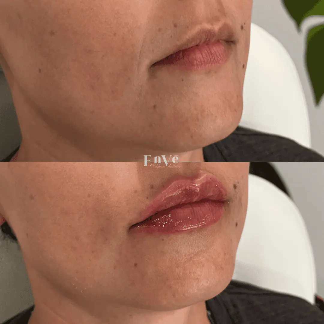 Before-and-after image showing noticeable facial rejuvenation and improved skin texture following treatment at Enve California Aesthetics.