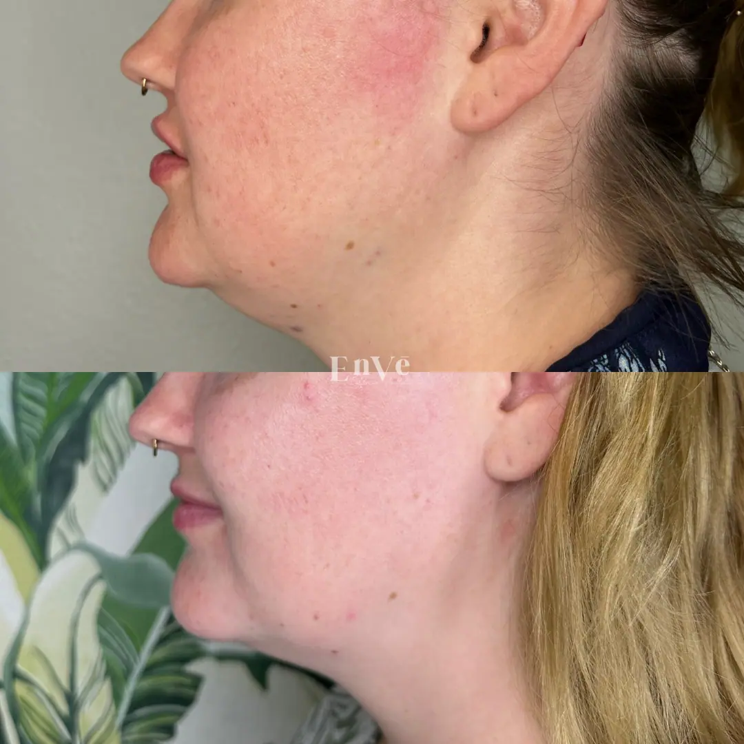 After-treatment image of female patient at Enve California Aesthetics in Palm Springs, CA – highlighting refined skin and youthful facial appearance.