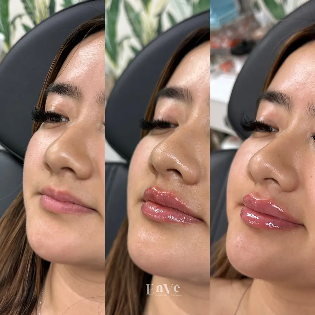 Before-and-after result improvements in skin texture and tone following a facial rejuvenation treatment at Enve Med Spa.