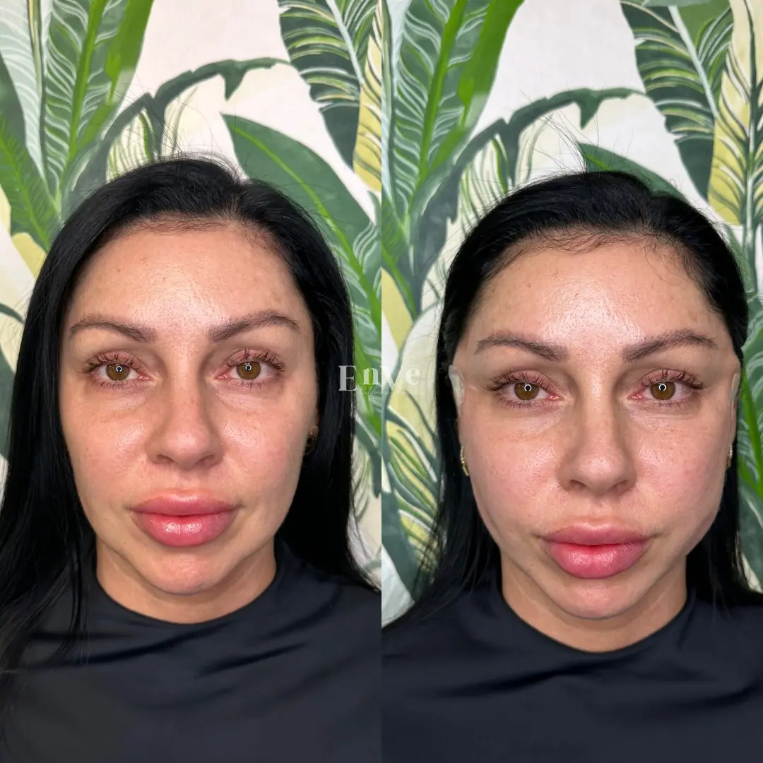 Botox before after treatment at Enve California Aesthetics in Palm Springs, CA