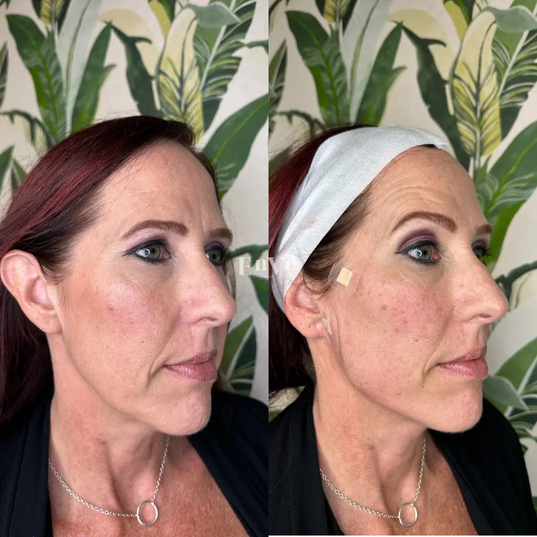 Woman after chin filler treatment at Enve California Aesthetics in Palm Springs, CA – showing enhanced chin contour and refined jawline.