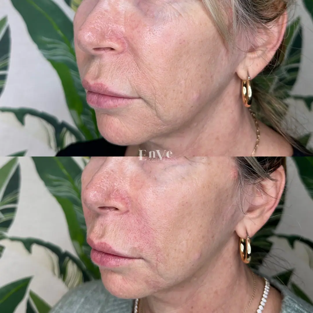 Chin filler results on female patient at Enve California Aesthetics in Palm Springs, CA – showcasing enhanced chin definition and balanced facial profile.